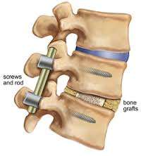 Arthrodèse vertébrale