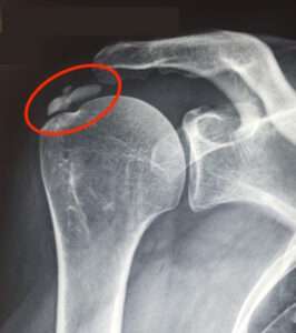 Calcification de l'épaule