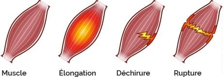 Different muscles injuries | MKDO - Physiotherapy & Osteopathy